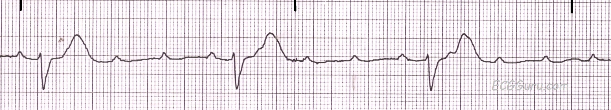 ECG Basics Third degree AV Block Complete Heart Block ECG Guru 